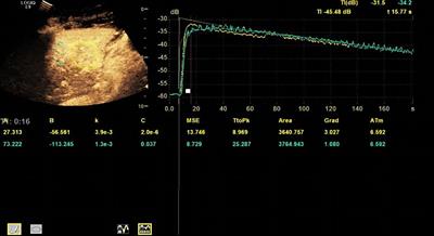 A contrast-enhanced ultrasound-based nomogram for the prediction of therapeutic efficiency of anti-PD-1 plus anti-VEGF agents in advanced hepatocellular carcinoma patients